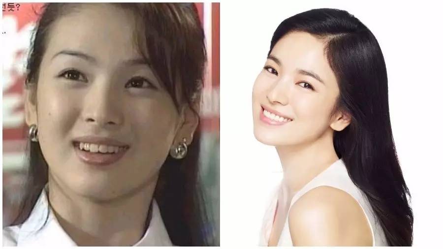 双眼皮手术韩式整形,韩国医生做幽灵手术