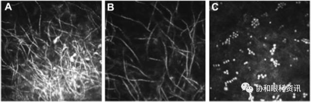 文摘速递丨共聚焦显微镜：角膜溃疡病原诊断的利器