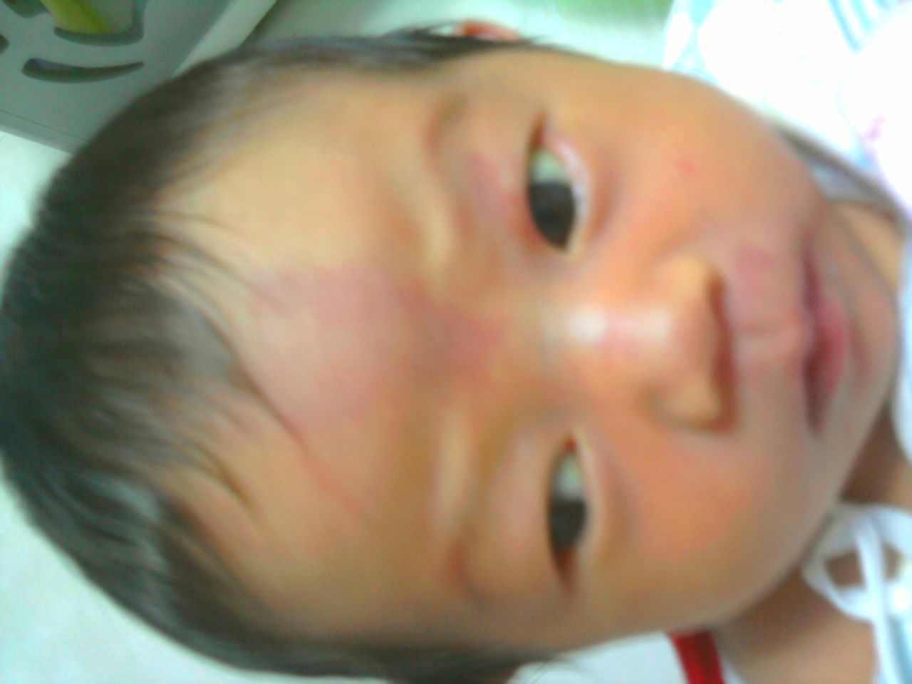 宝宝出生的胎痣多大才能治,新生儿胎痣图片