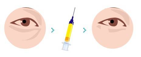 泪沟深怎么办,有了泪沟怎么补救