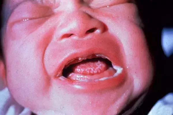 鹅鹅鹅鹅口疮，你需要知道这些