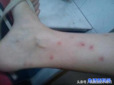 跳蚤咬的过敏症状图片,跳蚤咬的症状图片和危害