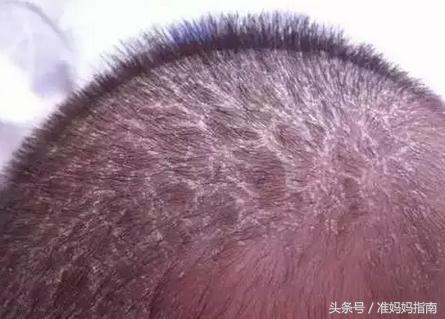 奶痂怎么去除最快方法,婴儿奶痂怎么才能去掉