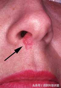 皮肤科疱疹,皮肤科一问一答