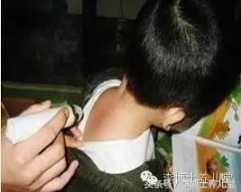 医生，你怎么用“大香烟”熏我家孩子？！