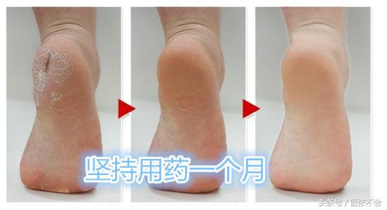 天气冷手脚干裂怎么办,秋冬季节手脚干裂用啥药