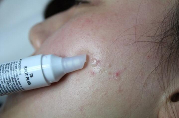 下巴和鼻子周围长痘痘,为什么鼻子周围红红的长痘痘痒