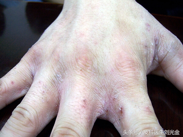 揭开谜团的真实事件,揭开皮肤病的真相