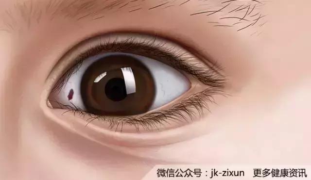 眼白上有黑点是怎么回事,眼白上的黑斑有影响吗