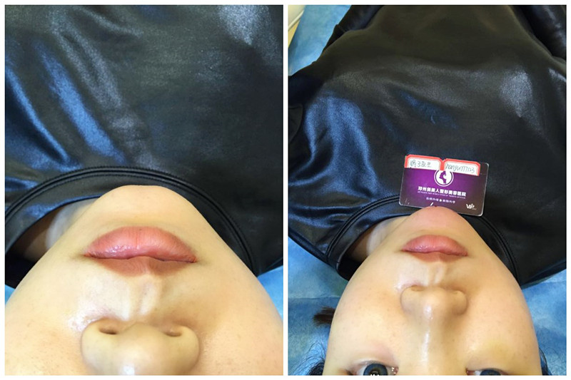 玻尿酸做微整形,玻尿酸微整和线雕提拉