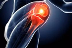 患了滑膜炎别慌张巧用这两种方法,哪些原因会引起出现滑膜炎