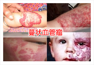 哪种方法可以治疗蔓状血管瘤,蔓状血管瘤治疗最好的方法