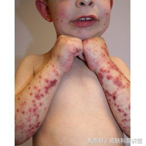 双小腿起红疹子是什么原因,双小腿出现有一片红点是什么原因