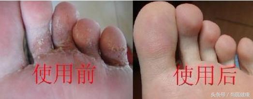 如何调理香港脚,有什么方法能够治愈香港脚