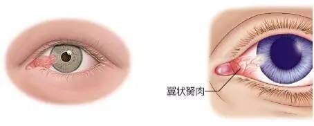 眼睛长胬肉能自然消失吗,眼睛里面长胬肉会怎么样