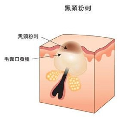 黑头容易弄掉吗,黑头真的除不干净吗