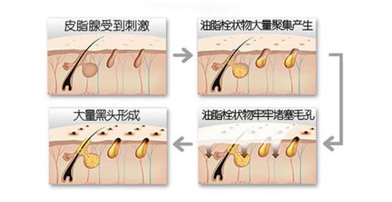 只有下巴反复长丘疹是什么原因,鼓起的硬痘痘