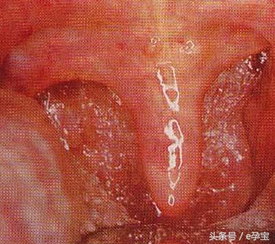 儿童扁桃体炎偏方,民间土方治咽炎偏方