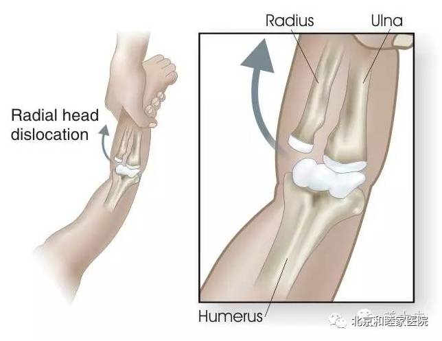 怎么牵宝宝胳膊防止脱臼,幼儿肘关节脱位复位后活动受限