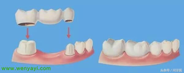 烤瓷牙真的不好吗,被牙医骗了做了烤瓷牙