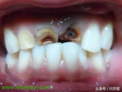 牙齿烂了怎么办治疗多少钱,牙齿蛀烂全过程