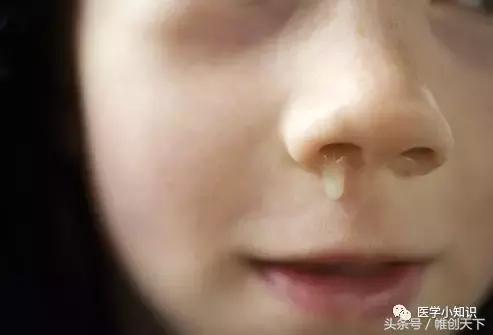 鼻窦炎临床治愈案例,鼻窦炎图片和治疗方法