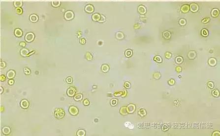 红斑狼疮肾炎有治好的例子吗,把疾病扼杀在摇篮里