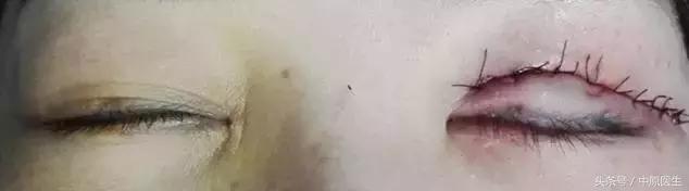 神奇：她左眼半年不能闭合，大夫在眼里给她装了个弹簧，可以了！