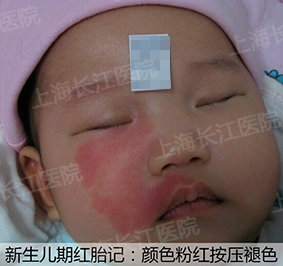 为什么红胎记会突出皮肤表面,光动力治红胎记失败