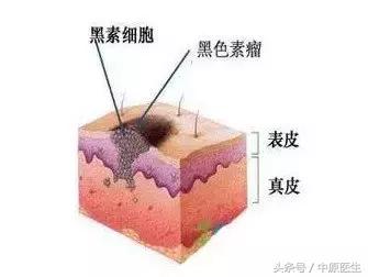 黑痣一旦恶化就是黑色素瘤吗,黑痣与黑色素瘤有区别吗