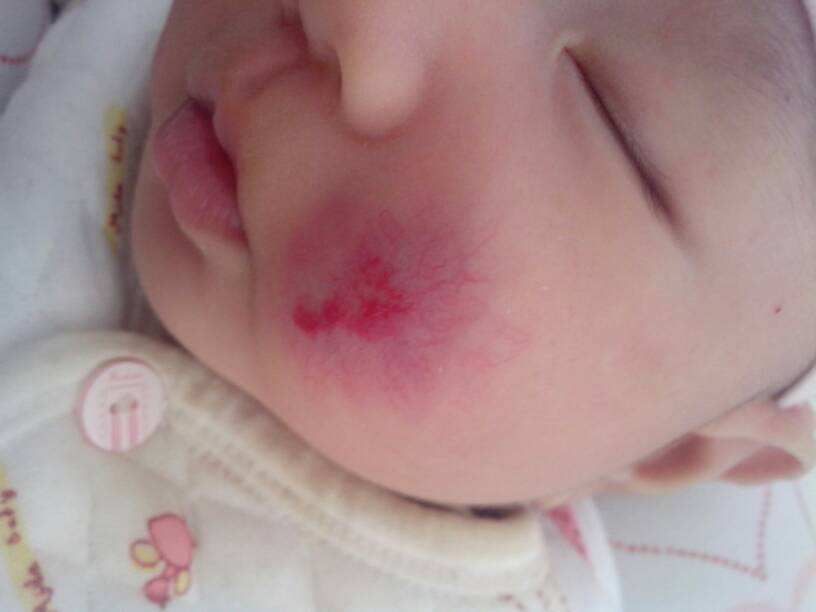 孩子脸上有像蜘蛛红色血丝,小孩脸上红色血丝怎么回事