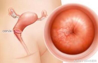 宫颈炎没有治疗会转变成hpv吗,宫颈炎会发展成为宫颈癌吗