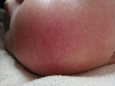 脸上有红色血丝怎么去除,新生儿脸上有红色血丝