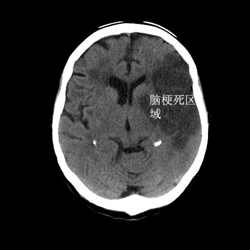 老年人头痛想吐什么原因,中老年人头晕想呕吐什么原因