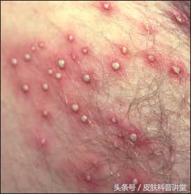 皮肤毛囊炎最简单自愈方法,皮肤科普小讲堂第一讲