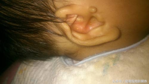 新生儿耳朵长个小附耳怎么造成的,5岁男童耳朵长副耳要住院吗