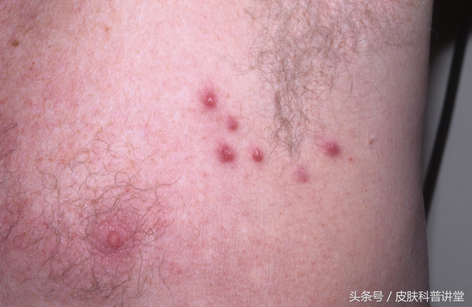 皮肤毛囊炎最简单自愈方法,皮肤科普小讲堂第一讲