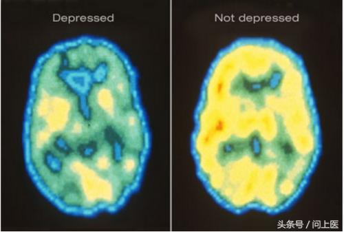 抑郁症的病因病机,抑郁症的病因症状