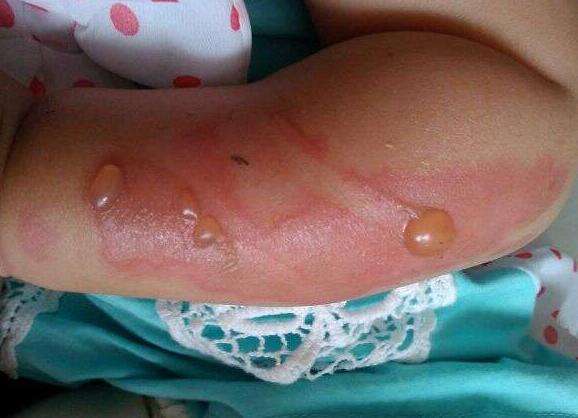 大面积烫伤掉皮了怎么处理好得快,被烫伤怎么处理最快最有效