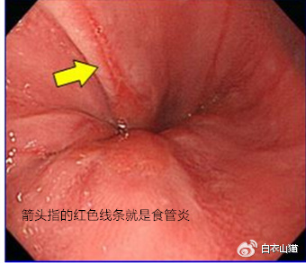 咽痛咳嗽吃消炎药没用,喉咙发炎医生让我管住嘴