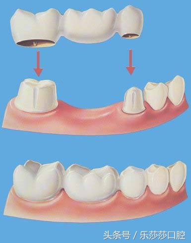 镶牙真的是一种错误吗,镶牙很假吗