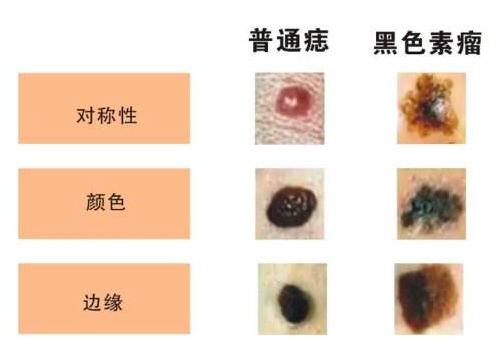 大痣旁边长小痣一定是癌变吗,最容易发生癌变的痣是哪种痣