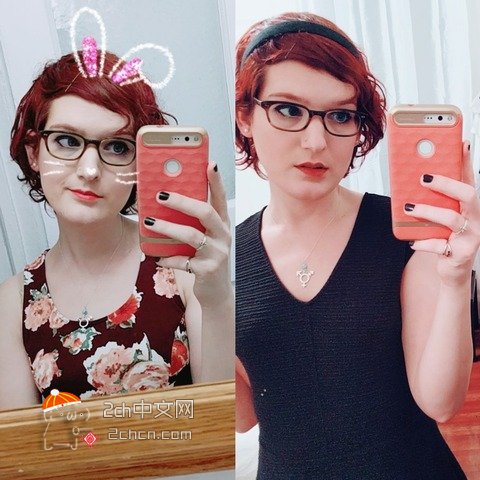 秃头大叔服用雌性激素,秃头男吃雌激素一年