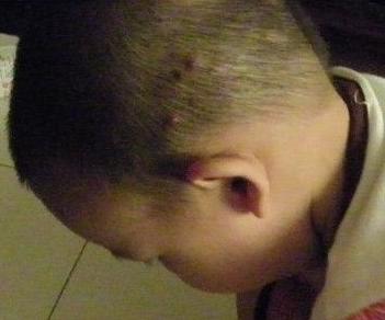 头皮长脓包怎么办用什么药膏,头皮长脓包怎么治疗用什么药