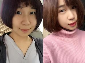 韩式三点双眼皮恢复单眼皮,韩式三点式双眼皮是永久性的吗