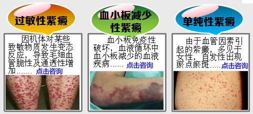 血小板紫癜饮食禁忌,血小板减少性紫癜症如何食疗