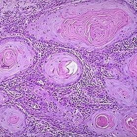 「推荐」读完此文,就会看宫颈癌筛查报告单了
