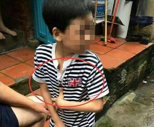 柳州一5岁孩子被小伙伴咬伤胸口，家长要求打狂犬疫苗！