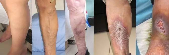 腿上青筋明显的中医辨证,怎样治愈腿上青筋