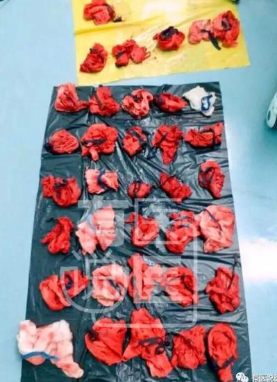 福建女子反复剖宫产子宫大出血被整个切除